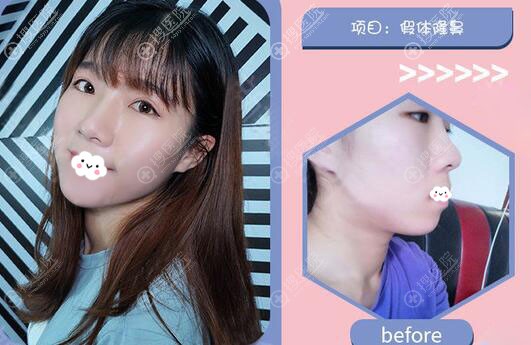 广州市佳人鼻综合隆鼻整形案例 广州市佳人鼻综合隆鼻整形案例