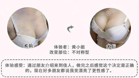 广州市佳人整形自体脂肪隆胸案例前后效果对比图 广州市佳人整形自体脂肪隆胸案例前后效果对比图