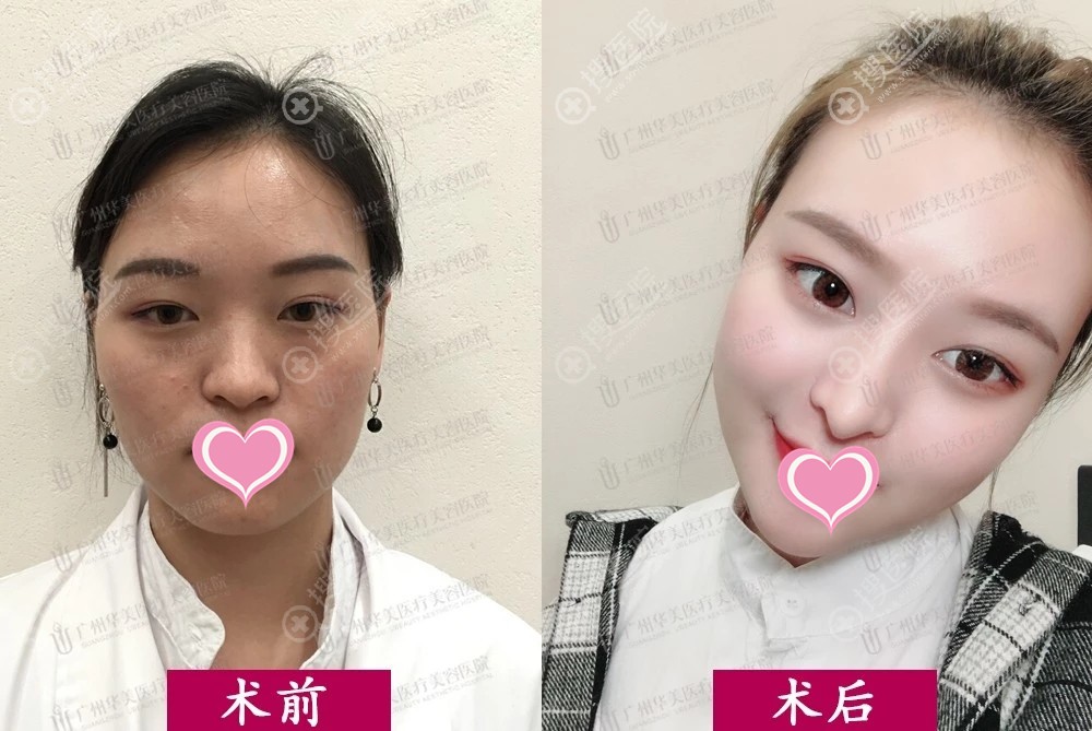 广东美恩自体脂肪改善面部 广东美恩自体脂肪改善面部