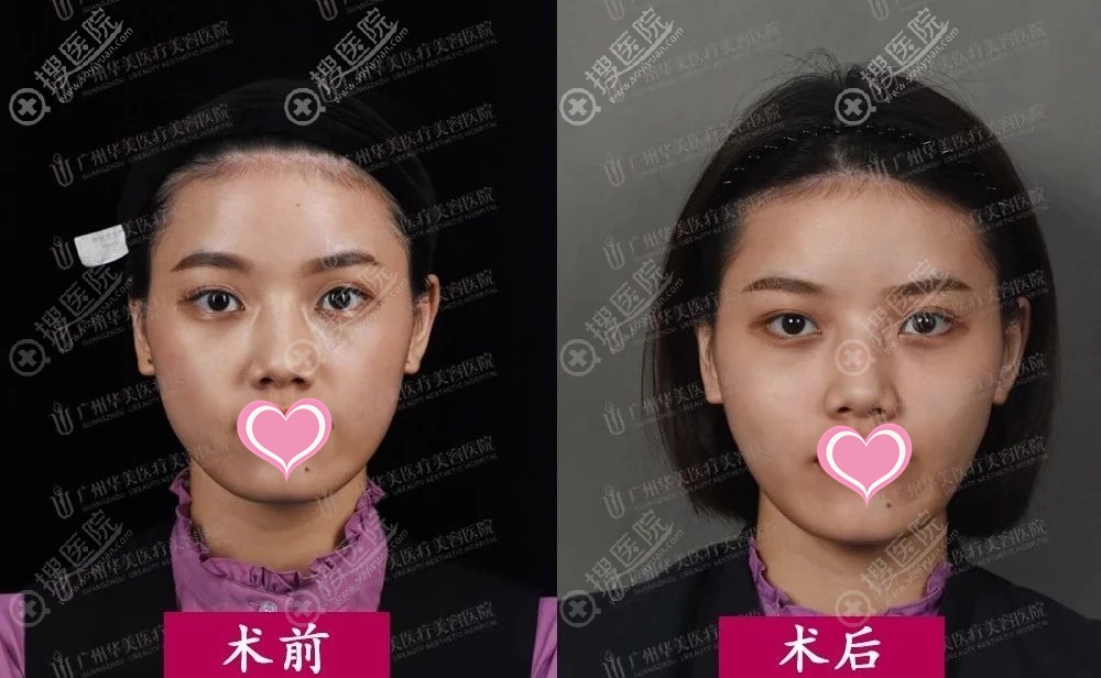 广东美恩玻尿酸填充效果明显 广东美恩玻尿酸填充效果明显