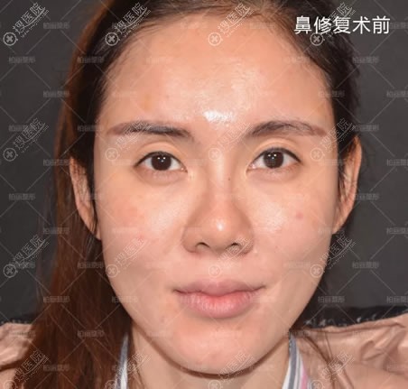 信了美容院的邪把鼻子做坏了,不得不飞到北京找李劲良做鼻修复