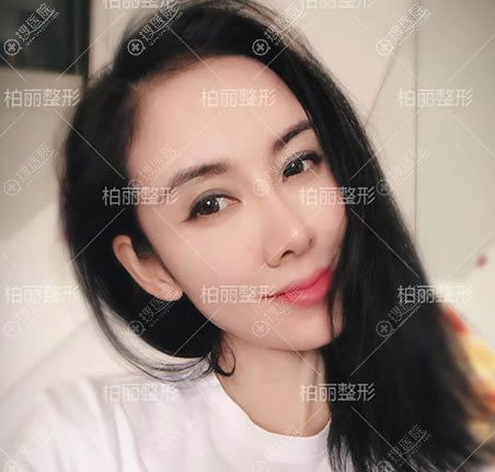 北京柏丽李劲良隆鼻失败修复案例 北京柏丽李劲良隆鼻失败修复案例