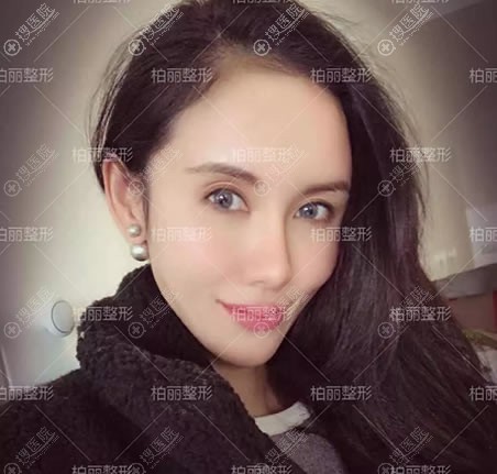 北京李劲良肋软骨鼻综合案例 北京李劲良肋软骨鼻综合案例