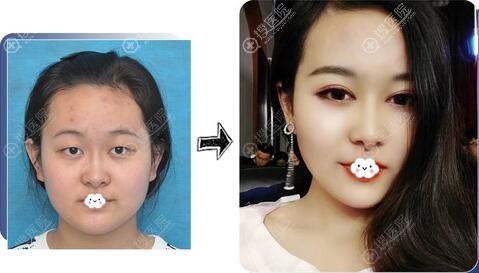 沈阳腾采孟强双眼皮案例 沈阳腾采孟强双眼皮案例