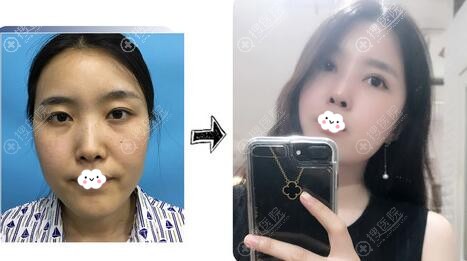 沈阳腾采孟强鼻综合隆鼻案例前后效果对比图 沈阳腾采孟强鼻综合隆鼻案例前后效果对比图