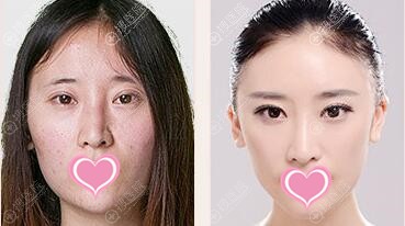 衡阳美莱自体脂肪填充面部效果 衡阳美莱自体脂肪填充面部效果
