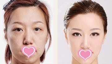 自体脂肪填充面部后对比图 自体脂肪填充面部后对比图