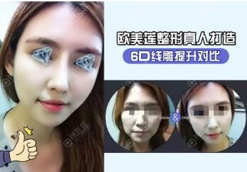白立明博士线雕提升对比效果 白立明博士线雕提升对比效果