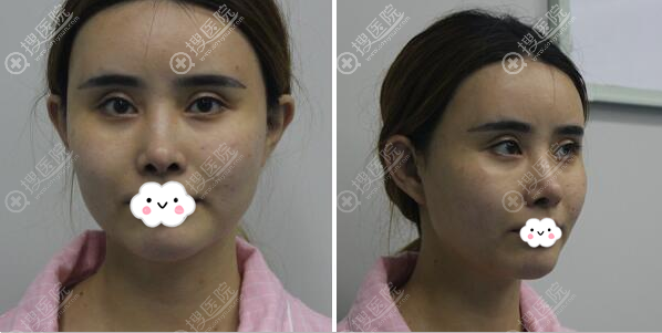 肋软骨隆鼻多久恢复?济南美神维纳斯杨芒利鼻综合术后恢复图