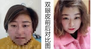 <!--<i data=20240710 data-id=9422></i>-->整形张兢双眼皮案例 <!--<i data=20240710 data-id=9422></i>-->整形张兢双眼皮案例