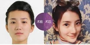 <!--<i data=20240710 data-id=9422></i>-->张兢注射玻尿酸隆鼻案例 <!--<i data=20240710 data-id=9422></i>-->张兢注射玻尿酸隆鼻案例