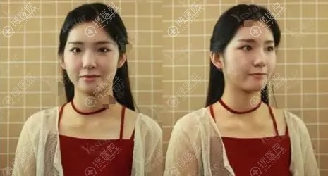 北京艺星通过吸脂和童颜胶填充实现了又想瘦又想美的生日愿望