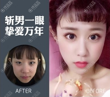 <!--<i data=20240710 data-id=11407></i>-->医院韩红乾双眼皮案例 <!--<i data=20240710 data-id=11407></i>-->医院韩红乾双眼皮案例