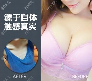 <!--<i data=20240710 data-id=11407></i>-->医院王家贵脂肪隆胸案例 <!--<i data=20240710 data-id=11407></i>-->医院王家贵脂肪隆胸案例