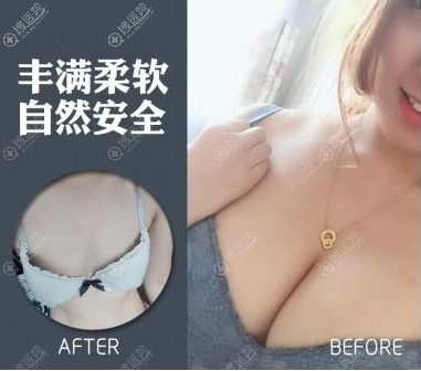<!--<i data=20240710 data-id=11407></i>-->医院假体隆胸案例 <!--<i data=20240710 data-id=11407></i>-->医院假体隆胸案例