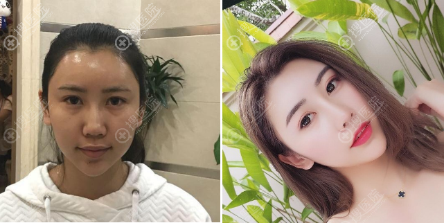 <!--<i data=20240710 data-id=11407></i>-->医院王家贵做的隆鼻案例 <!--<i data=20240710 data-id=11407></i>-->医院王家贵做的隆鼻案例