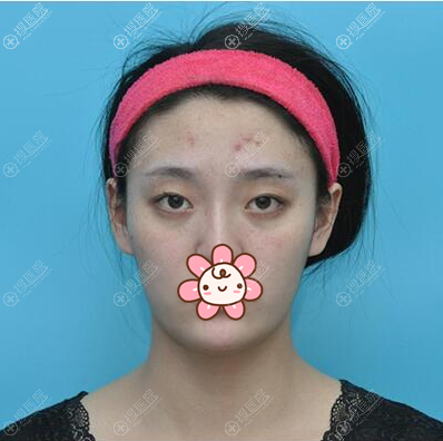 觉得沈阳腾采侯莉医生专业负责,找她给我做了双眼皮手术