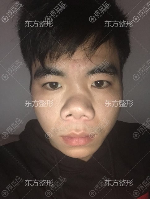 南宁东方整形龙海波、徐国建、刘刚联合打造歪鼻矫正公益案例