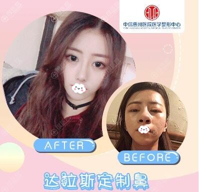 中信惠州医院罗秋雄达拉斯定制鼻综合案例前后效果对比图 中信惠州医院罗秋雄达拉斯定制鼻综合案例前后效果对比图