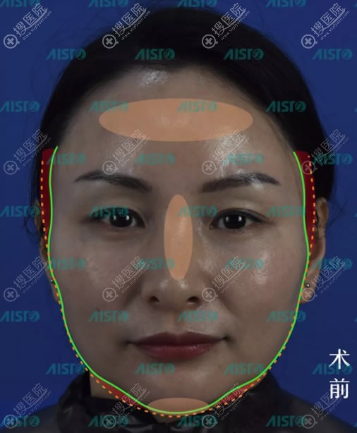 我在重庆爱思特做了脸部自体脂肪填充就从干瘪脸秒变少女颜了