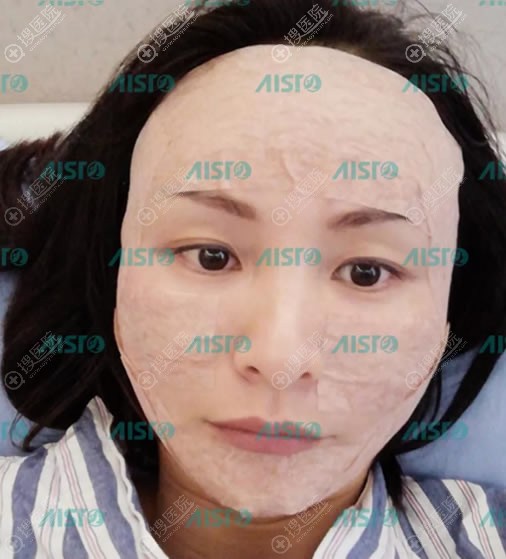 重庆爱思特刚做完脂肪填充效果 重庆爱思特刚做完脂肪填充效果