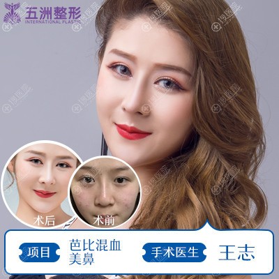 武汉五洲莱美王志鼻综合隆鼻案例 武汉五洲莱美王志鼻综合隆鼻案例