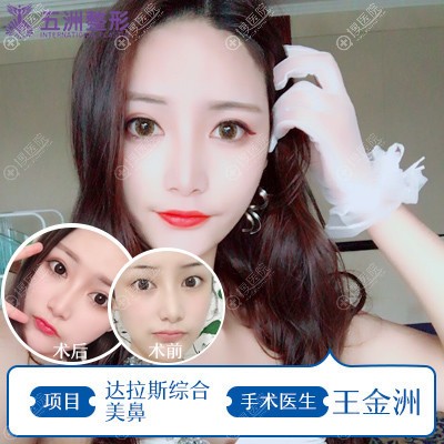 武汉五洲莱美王金洲达拉斯鼻综合隆鼻案例 武汉五洲莱美王金洲达拉斯鼻综合隆鼻案例