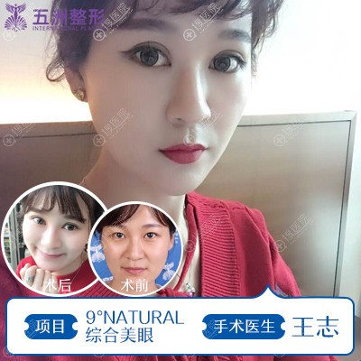 武汉五洲莱美王志做的双眼皮眼综合案例 武汉五洲莱美王志做的双眼皮眼综合案例