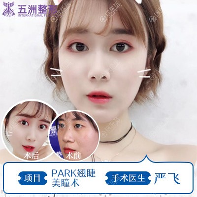 武汉五洲莱美严飞做双眼皮怎么样 武汉五洲莱美严飞做双眼皮怎么样