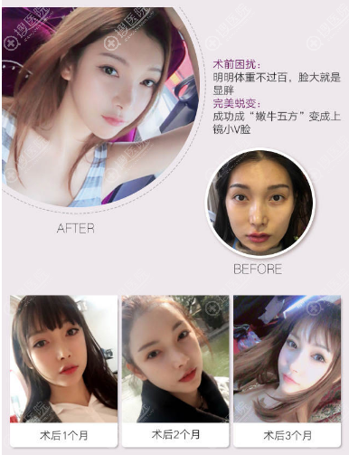 武汉五洲莱美刘骏做的下颌角整形案例 武汉五洲莱美刘骏做的下颌角整形案例
