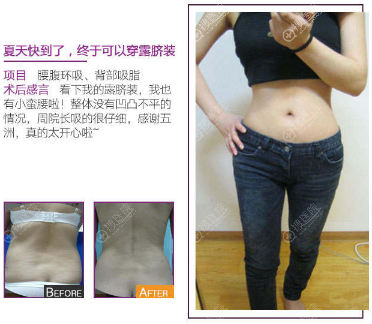 武汉五洲莱美周旭刚腰腹部吸脂案例 武汉五洲莱美周旭刚腰腹部吸脂案例