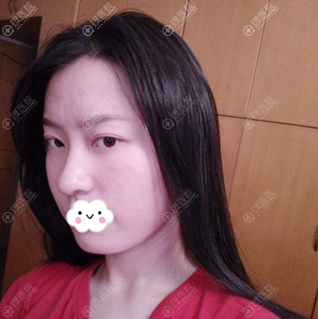 我找重庆时光河东镐做下颌角整形亲身经历告诉你术后多久消肿?
