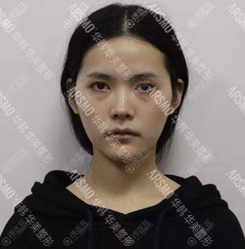 了解脂肪胶、纳米脂肪和自体脂肪的区别后做了纳米脂肪胶填充