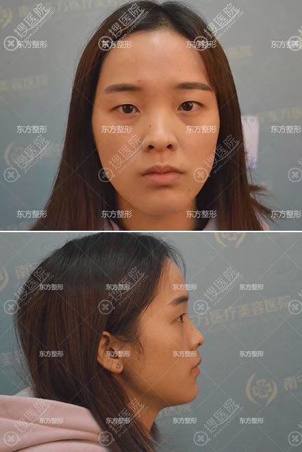 作为南宁本土人来告诉你南宁东方整容医院做隆鼻双眼皮怎么样