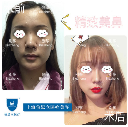上海伯思立(百达丽)别筝主任肋软骨隆鼻案例 上海伯思立(百达丽)别筝主任肋软骨隆鼻案例