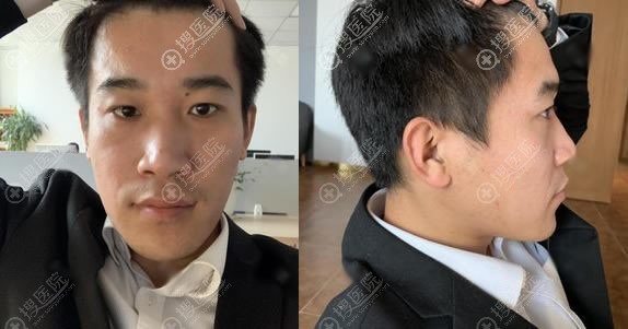 在苏州卫康整形给鼻子打了0.5的伊婉V玻尿酸隆鼻,花了980元钱