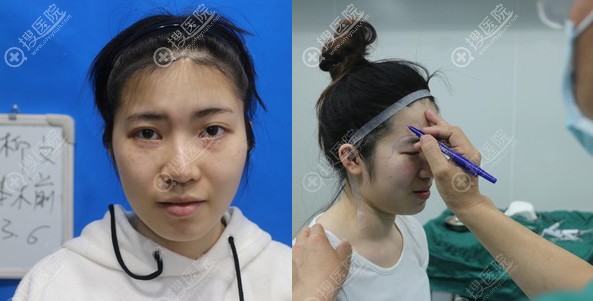 <!--<i data=20240710 data-id=11938></i>-->面部填充术前照片 <!--<i data=20240710 data-id=11938></i>-->面部填充术前照片