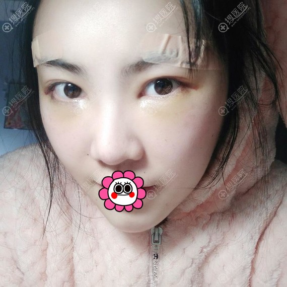 <!--<i data=20240710 data-id=16754></i>-->做的面部脂肪填充术后一周 <!--<i data=20240710 data-id=16754></i>-->做的面部脂肪填充术后一周