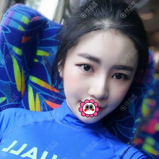 南这贺尔美自体脂肪面部填充恢复一个月效果 南这贺尔美自体脂肪面部填充恢复一个月效果