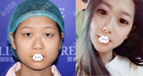 东阳丽来双眼皮真人案例前后效果对比图 东阳丽来双眼皮真人案例前后效果对比图