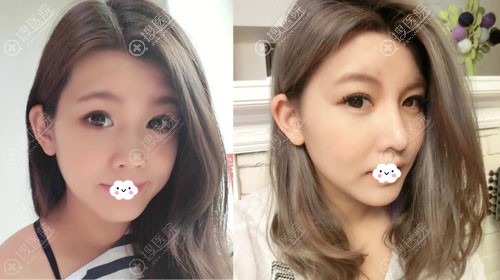 东阳丽莱硅胶假体隆鼻效果对比图 东阳丽莱硅胶假体隆鼻效果对比图
