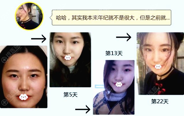 东阳丽莱恢复过程 东阳丽莱恢复过程