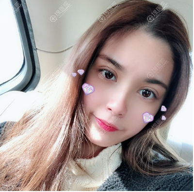 <!--<i data=20240710 data-id=12169></i>-->双眼皮案例术后效果图 <!--<i data=20240710 data-id=12169></i>-->双眼皮案例术后效果图