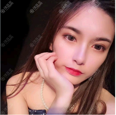 <!--<i data=20240710 data-id=12169></i>-->俞静医生做的双眼皮案例 <!--<i data=20240710 data-id=12169></i>-->俞静医生做的双眼皮案例