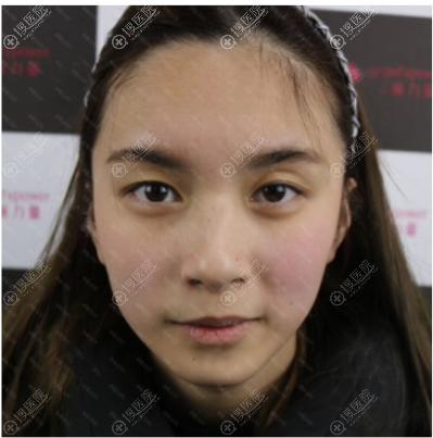 <!--<i data=20240710 data-id=12169></i>-->双眼皮术前照片 <!--<i data=20240710 data-id=12169></i>-->双眼皮术前照片