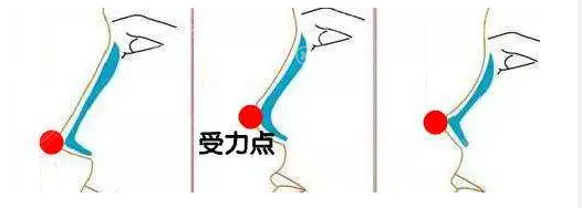 普通隆鼻手术示意图 普通隆鼻手术示意图