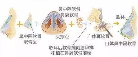 上海伯思立别筝综合鼻整形示意图 上海伯思立别筝综合鼻整形示意图