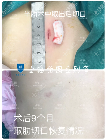 上海伯思立别筝肋软骨切口恢复图片 上海伯思立别筝肋软骨切口恢复图片