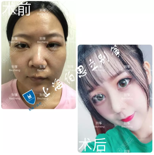 上海伯思立别筝做的全肋软骨隆鼻案例 上海伯思立别筝做的全肋软骨隆鼻案例
