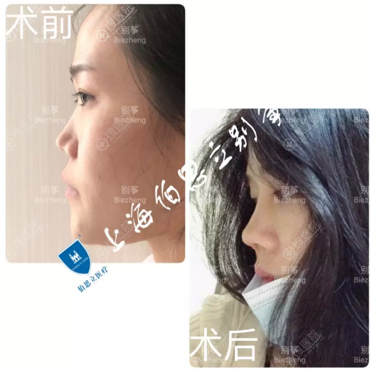 上海伯思立别筝做的半肋软骨隆鼻案例 上海伯思立别筝做的半肋软骨隆鼻案例